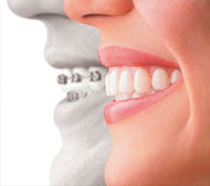 Invisalign Treatment in St Kilda