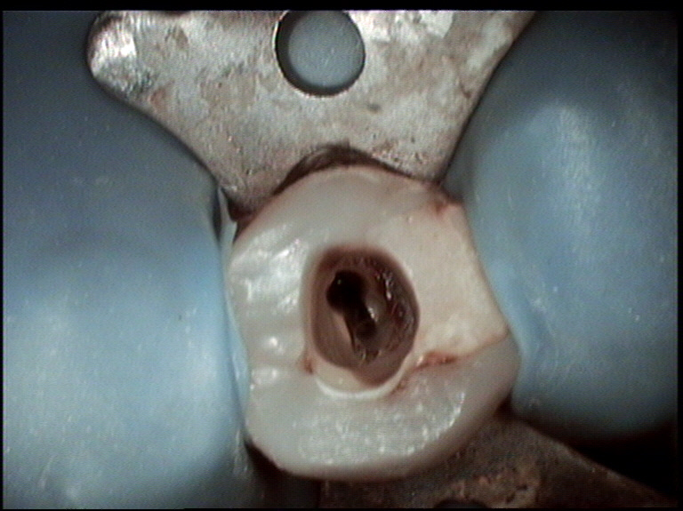 Root Canal