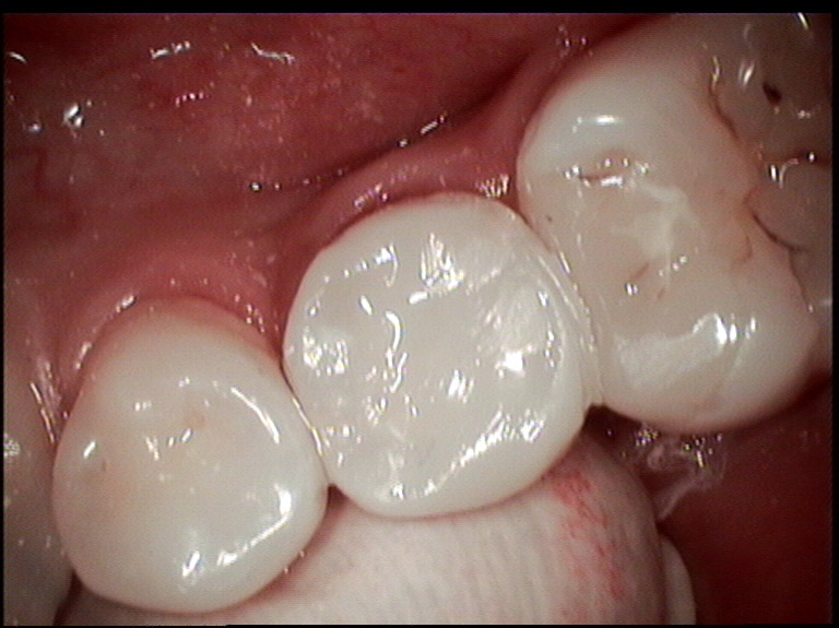 Tooth Rebuilt